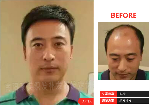 男士補發(fā)案例