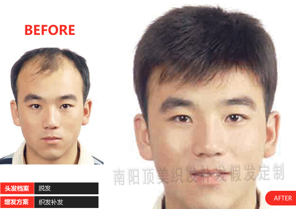 男士補發(fā)案例