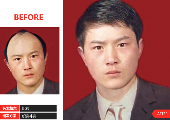 男士補發(fā)案例
